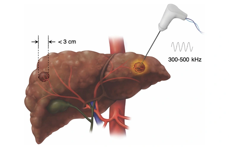 Oncology interventions 02